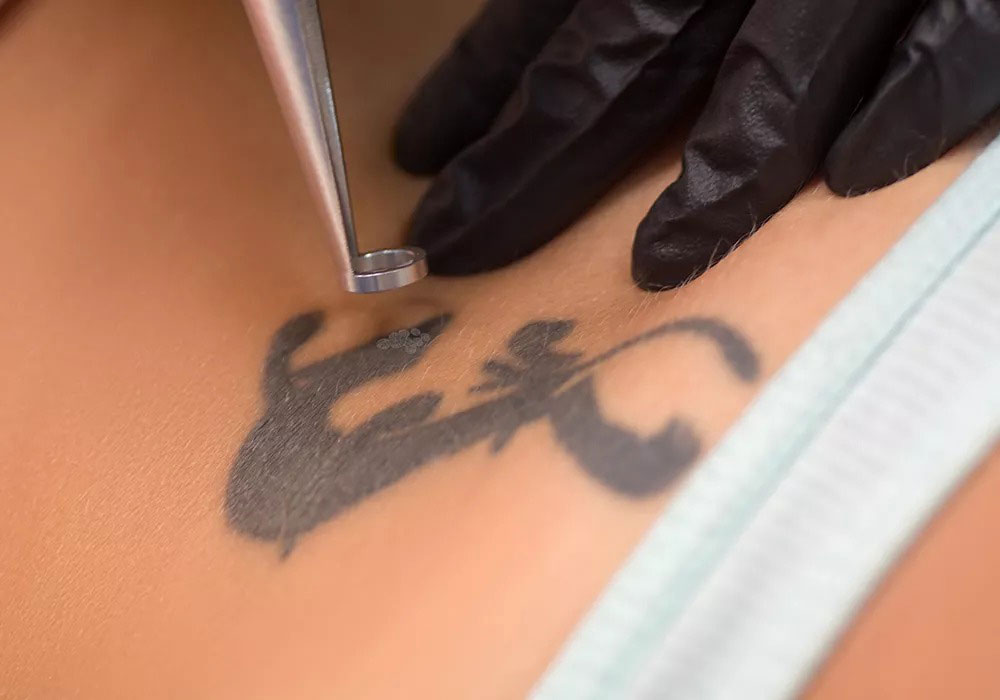 Speed détatouage au Havre