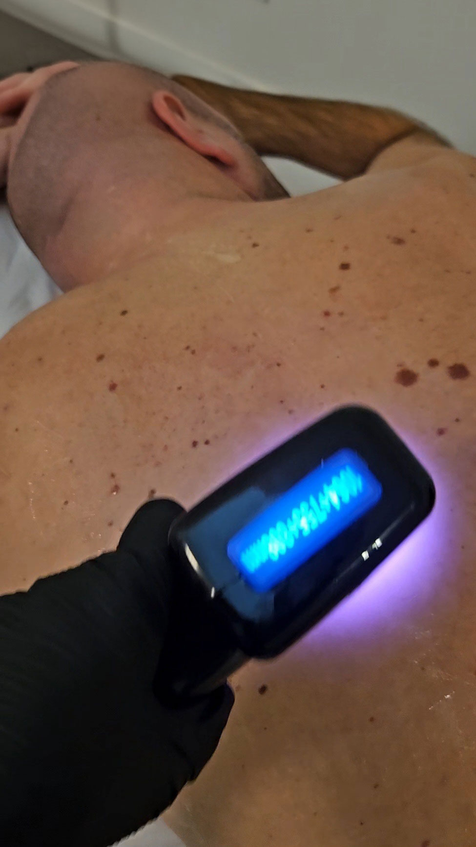 Épilation définitive au Havre